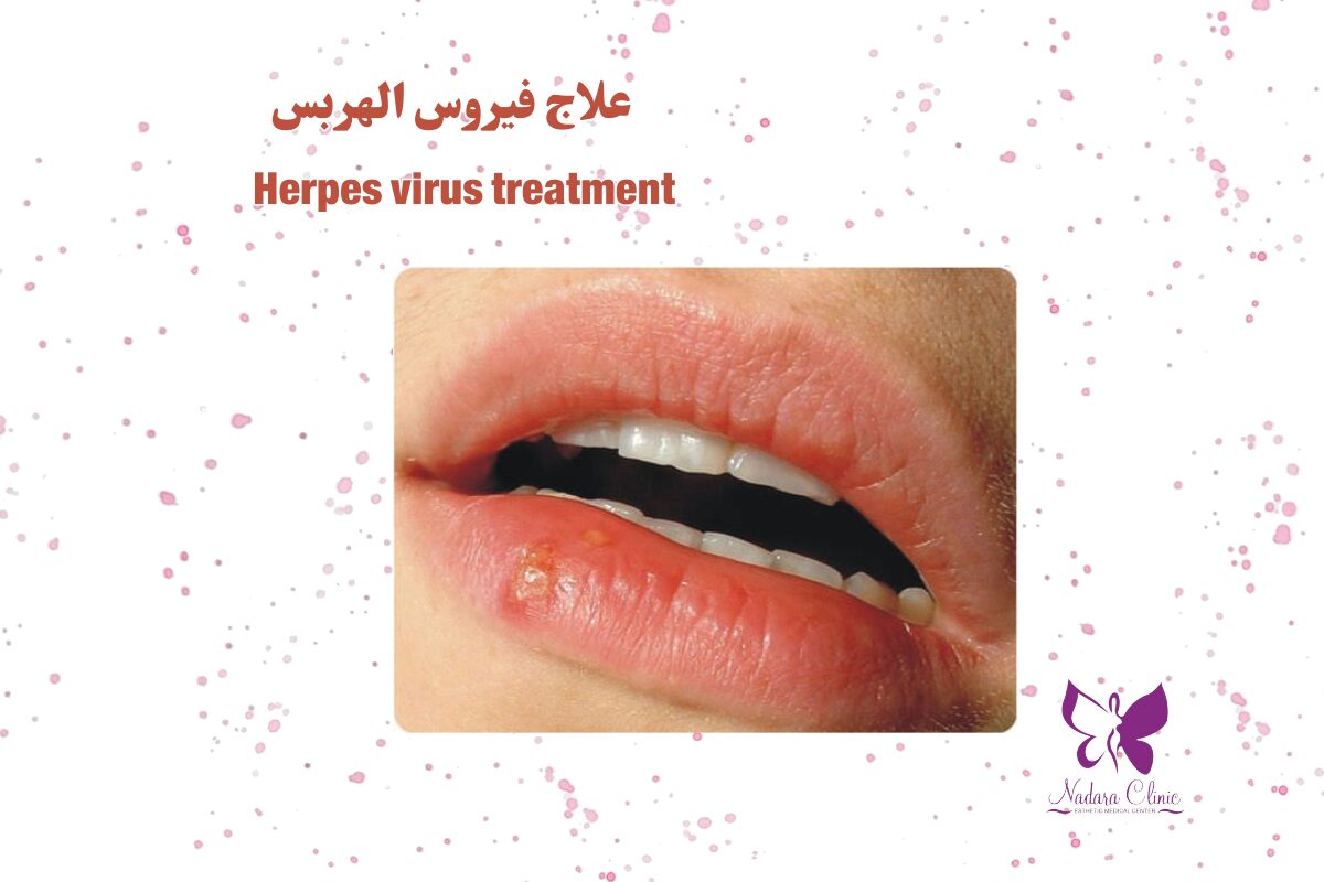 Herpes virus treatment in Hurghada
